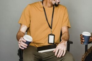 أحدث علاج للبهاق
